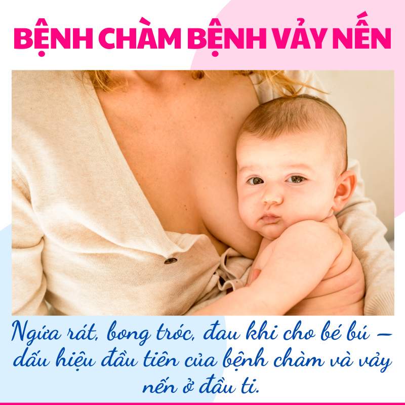 dấu hiệu nhận biết bệnh tràm bệnh vẩy nến